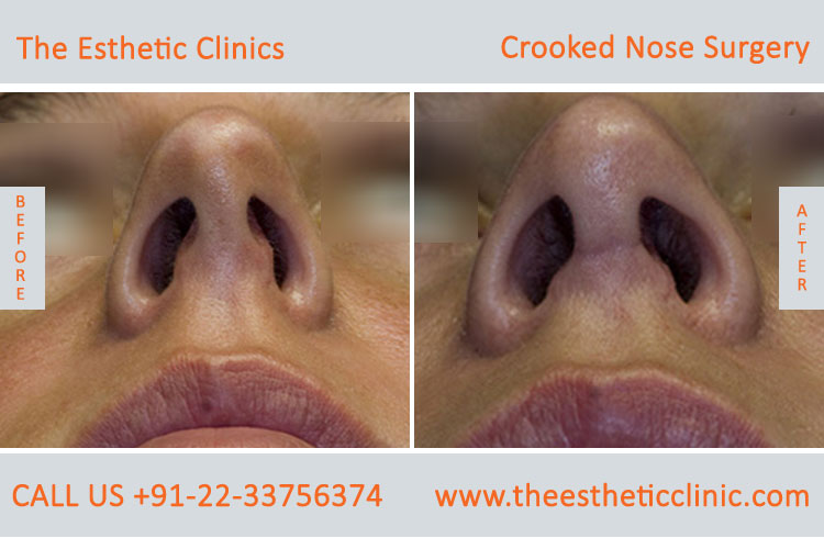 Crooked Nose Surgery before after photos in mumbai india (5)